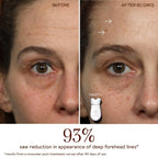 Trinity+ LED Red Light Wrinkle Reducer Attachment